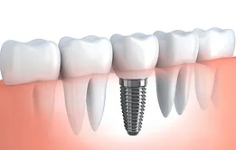 Dental Implants