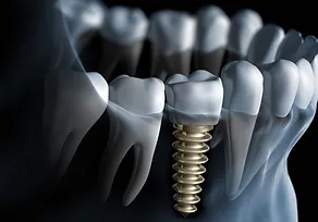 Home 2016 07 29 1469804112 9503073 dentalimpl.webp
