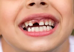 Home tooth decay the tooth doctor.webp